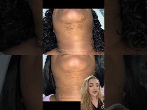 womans chin before and after pictures