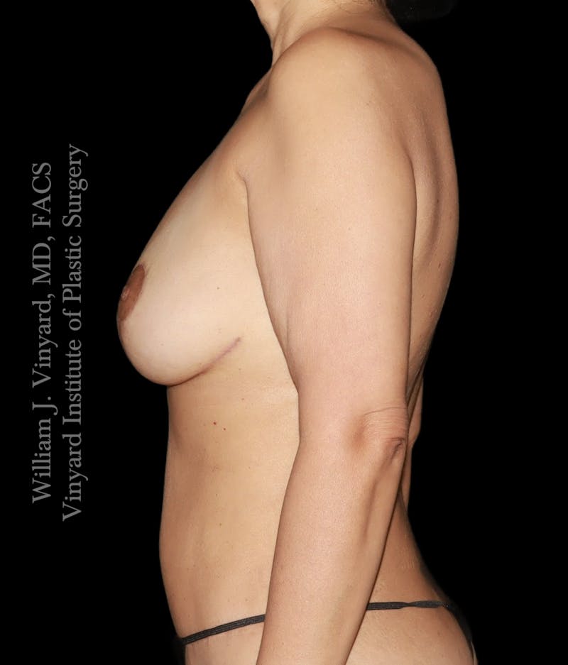 Breast Lift Before & After Gallery - Patient 119664 - Image 10