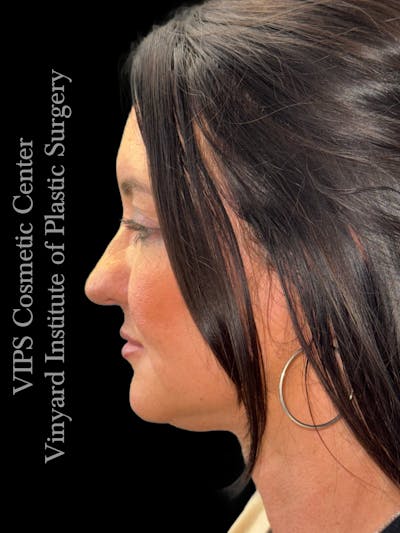 Morpheus8 RF Microneedling Before & After Gallery - Patient 353291 - Image 2
