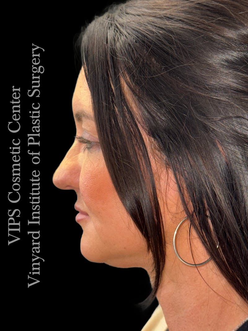 Morpheus8 RF Microneedling Before & After Gallery - Patient 353291 - Image 2
