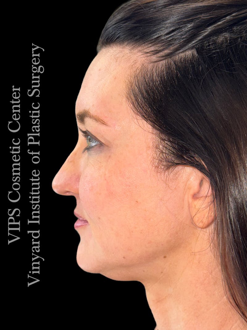 Morpheus8 RF Microneedling Before & After Gallery - Patient 353291 - Image 1