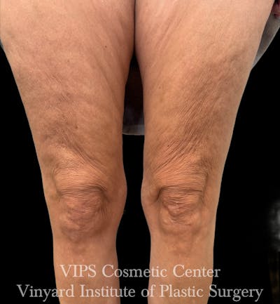 Morpheus8 BODY RF Microneedling Before & After Gallery - Patient 416612 - Image 1