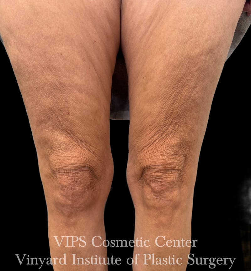 Morpheus8 BODY RF Microneedling Before & After Gallery - Patient 416612 - Image 1