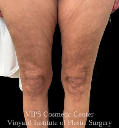 Morpheus8 BODY RF Microneedling Before & After Gallery - Patient 416612 - Image 2