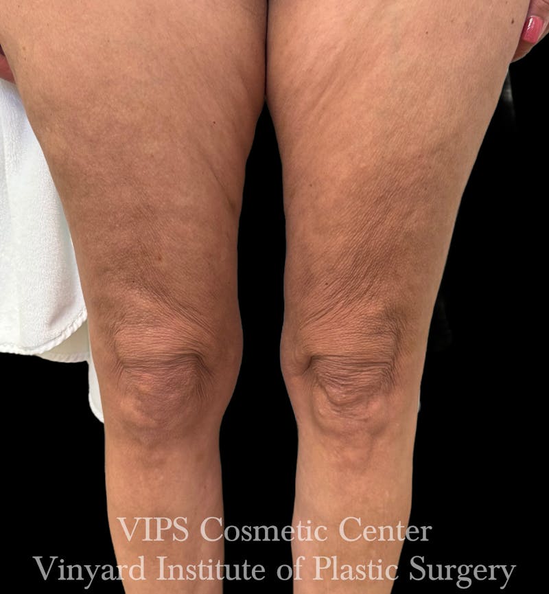 Morpheus8 BODY RF Microneedling Before & After Gallery - Patient 416612 - Image 2