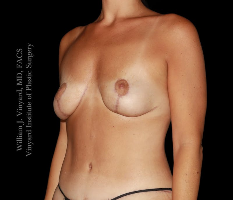 Breast Lift Before & After Gallery - Patient 146641 - Image 8