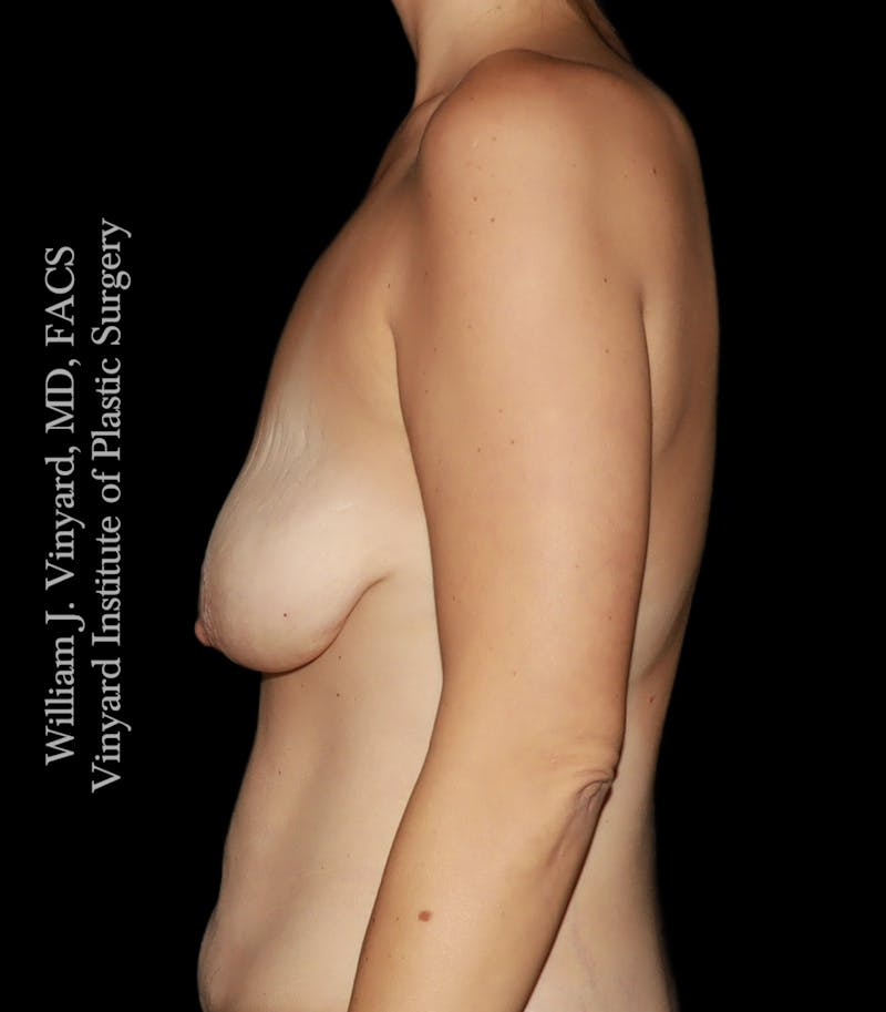 Breast Lift Before & After Gallery - Patient 146641 - Image 9