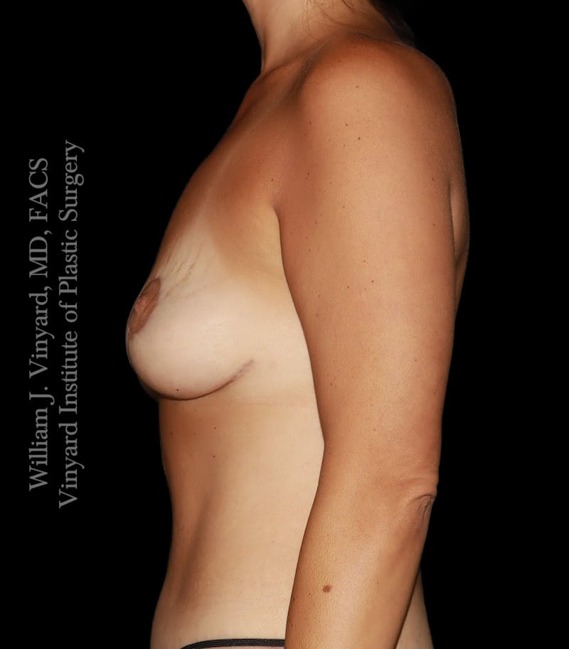 Breast Lift Before & After Gallery - Patient 146641 - Image 10