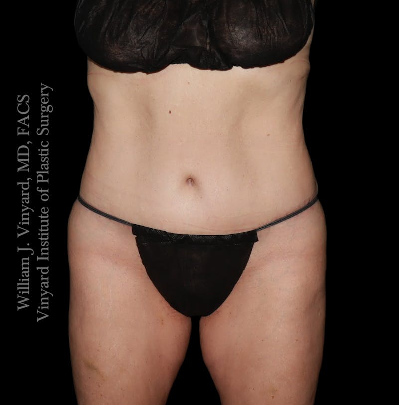 Tummy Tuck Before & After Gallery - Patient 182029 - Image 2