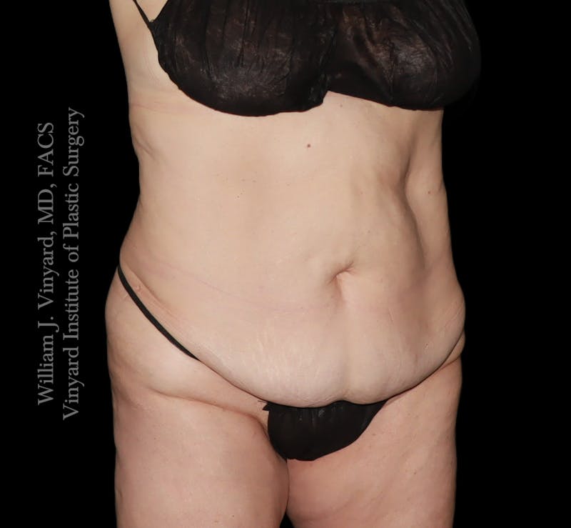 Tummy Tuck Before & After Gallery - Patient 182029 - Image 3