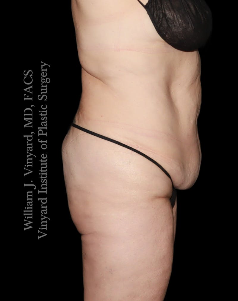 Tummy Tuck Before & After Gallery - Patient 182029 - Image 5