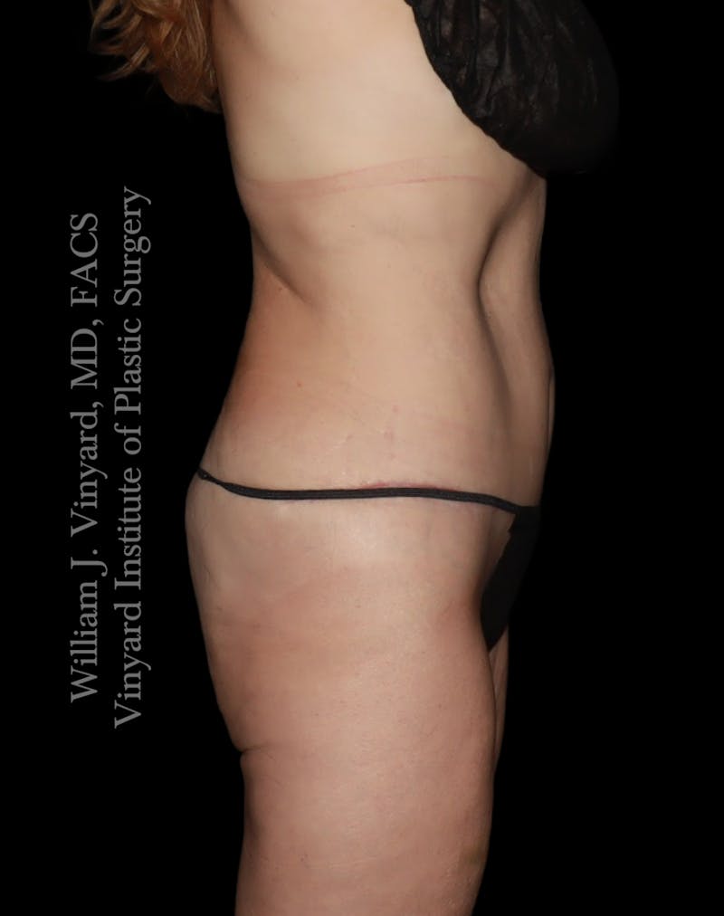 Tummy Tuck Before & After Gallery - Patient 182029 - Image 6