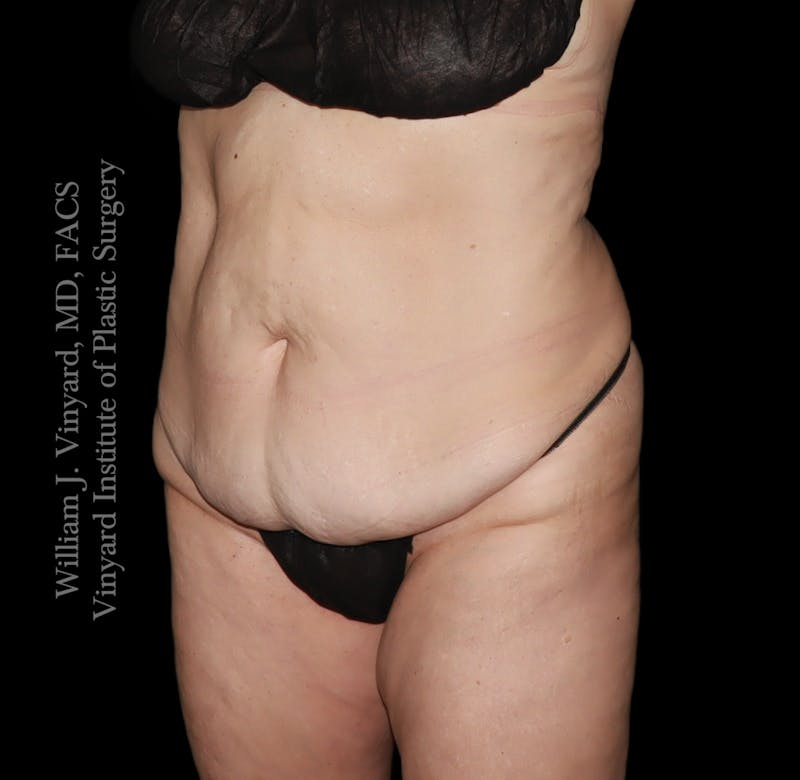 Tummy Tuck Before & After Gallery - Patient 182029 - Image 7