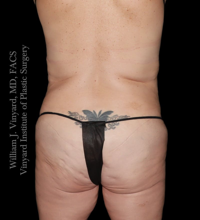 Tummy Tuck Before & After Gallery - Patient 182029 - Image 11