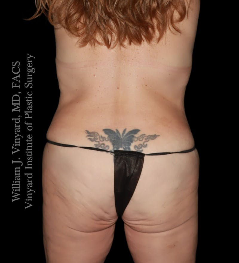 Tummy Tuck Before & After Gallery - Patient 182029 - Image 12