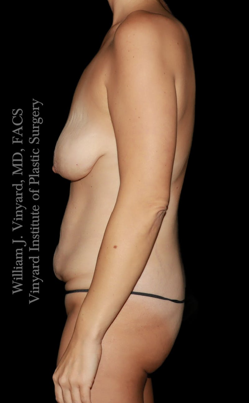 Mommy Makeover Before & After Gallery - Patient 390305 - Image 9
