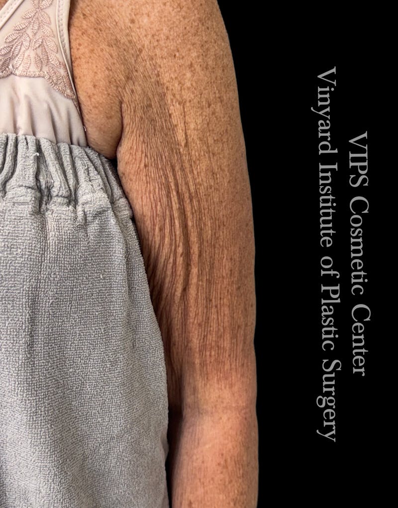 Morpheus8 BODY RF Microneedling Before & After Gallery - Patient 370740 - Image 1