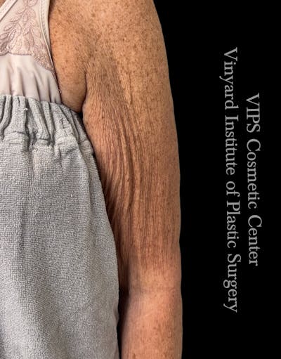 Morpheus8 BODY RF Microneedling Before & After Gallery - Patient 370740 - Image 1