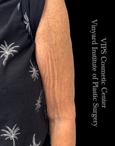 Morpheus8 BODY RF Microneedling Before & After Gallery - Patient 370740 - Image 2