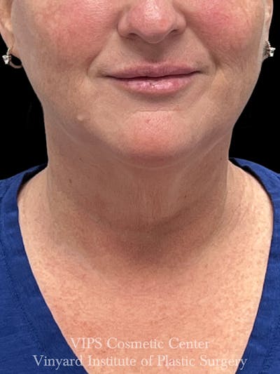 Morpheus8 RF Microneedling Before & After Gallery - Patient 307457 - Image 2