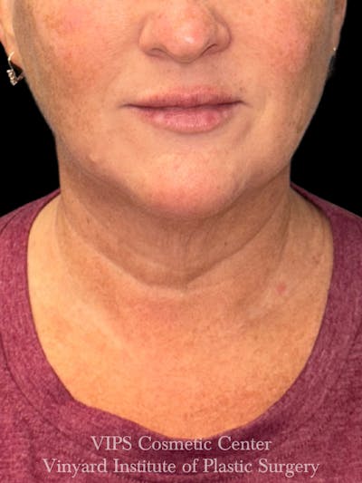 Morpheus8 RF Microneedling Before & After Gallery - Patient 307457 - Image 1