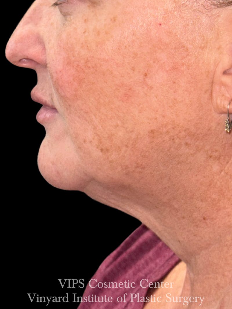 Morpheus8 RF Microneedling Before & After Gallery - Patient 307457 - Image 3