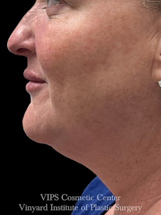 Morpheus8 RF Microneedling Before & After Gallery - Patient 307457 - Image 4