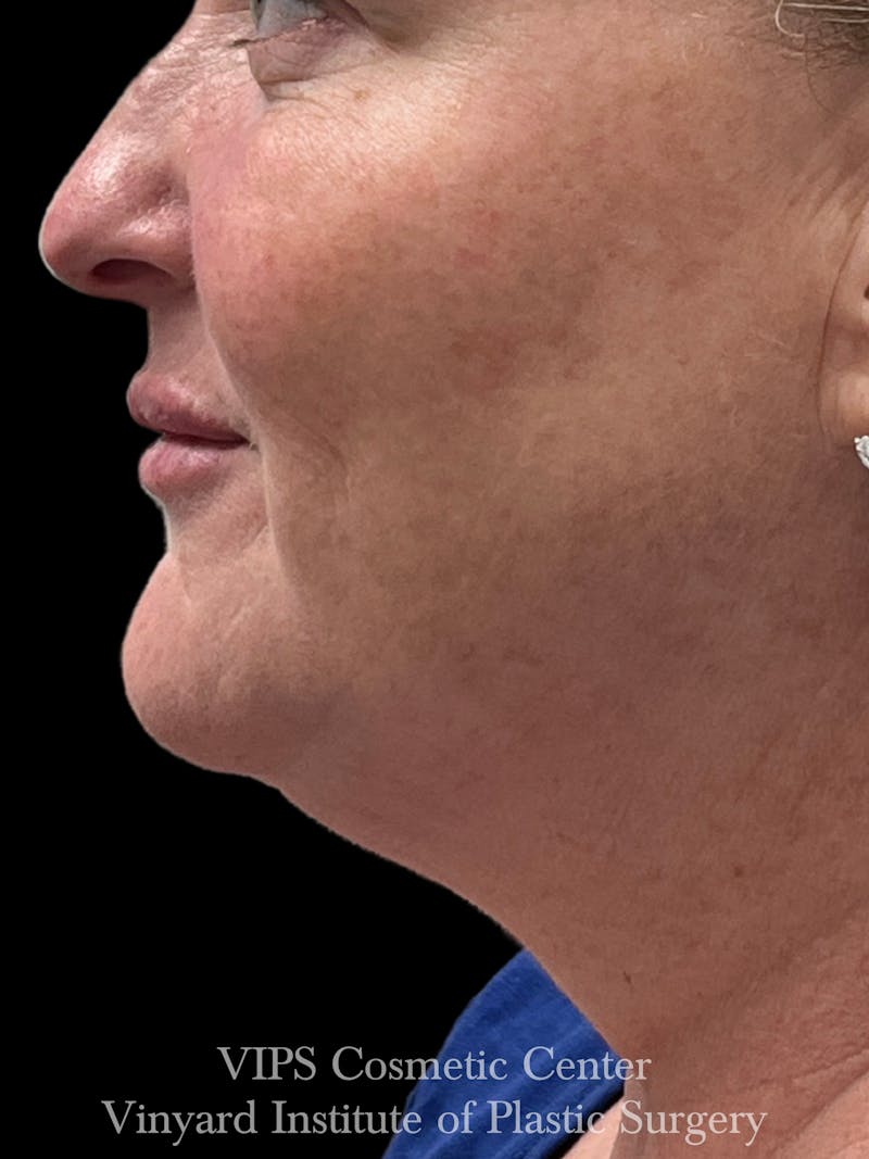 Morpheus8 RF Microneedling Before & After Gallery - Patient 307457 - Image 4
