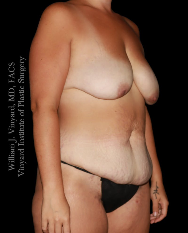 Mommy Makeover Before & After Gallery - Patient 458954 - Image 3