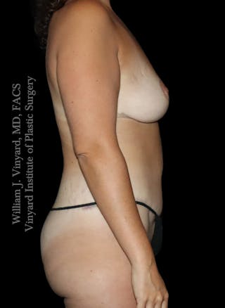 Mommy Makeover Before & After Gallery - Patient 458954 - Image 6
