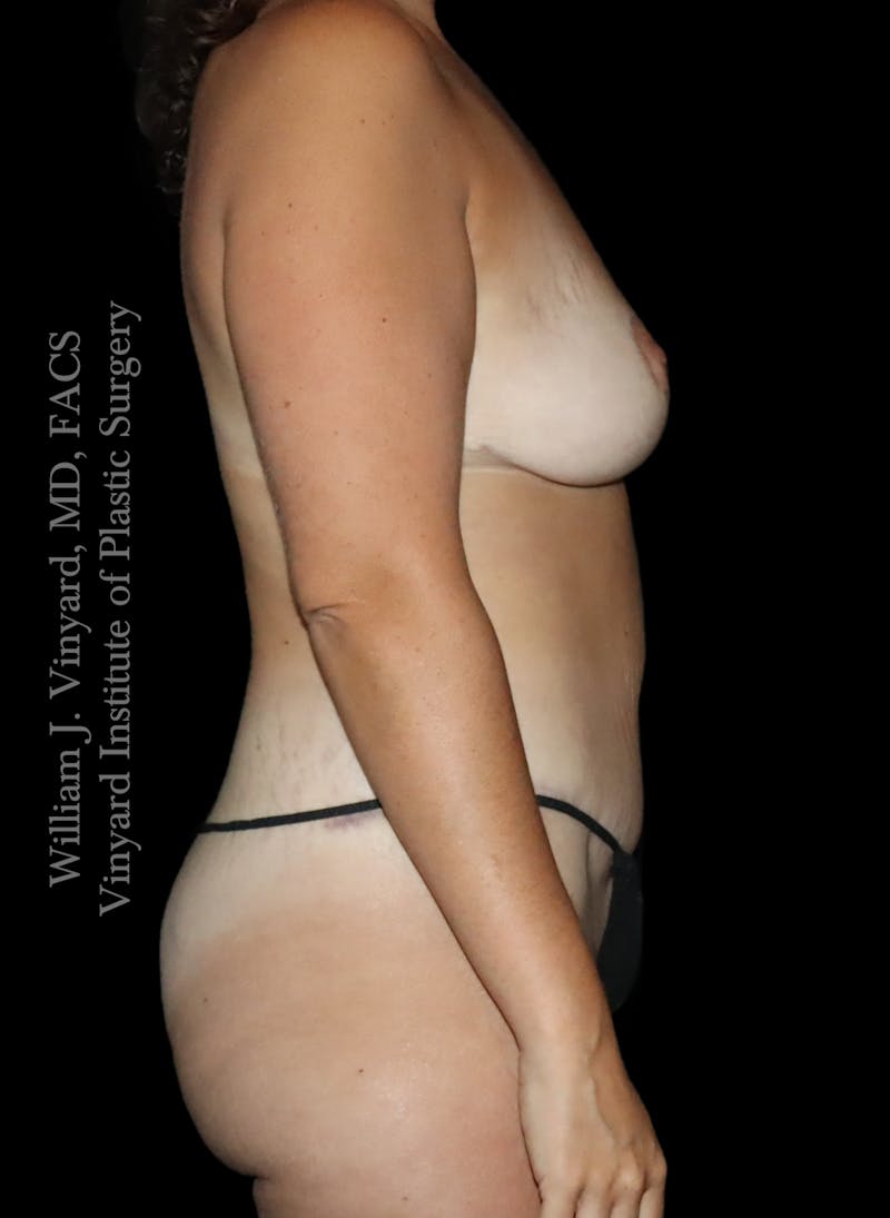 Mommy Makeover Before & After Gallery - Patient 458954 - Image 6