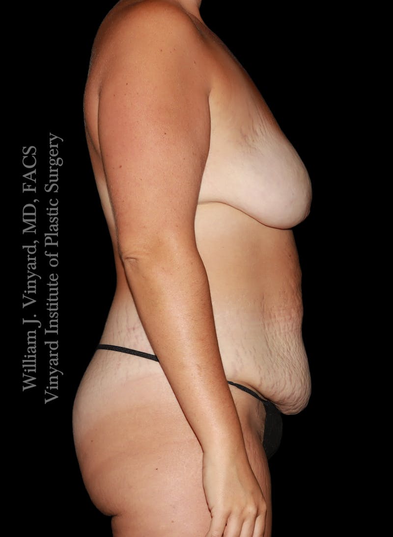 Mommy Makeover Before & After Gallery - Patient 458954 - Image 5