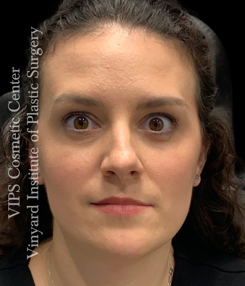 BOTOX® Before & After Gallery - Patient 379979 - Image 2
