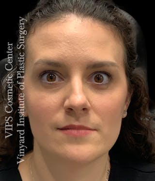 BOTOX® Before & After Gallery - Patient 379979 - Image 2