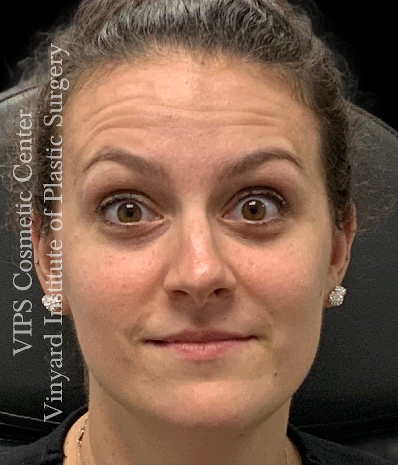 BOTOX® Before & After Gallery - Patient 379979 - Image 1