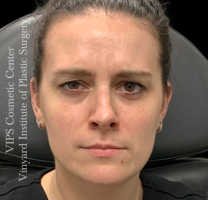 BOTOX® Before & After Gallery - Patient 379979 - Image 4