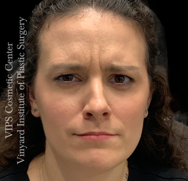BOTOX® Before & After Gallery - Patient 379979 - Image 3