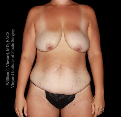 Mommy Makeover Before & After Gallery - Patient 458954 - Image 1
