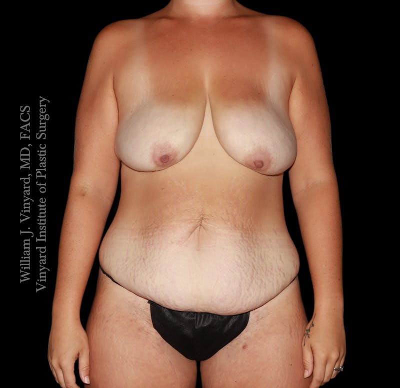 Mommy Makeover Before & After Gallery - Patient 458954 - Image 1