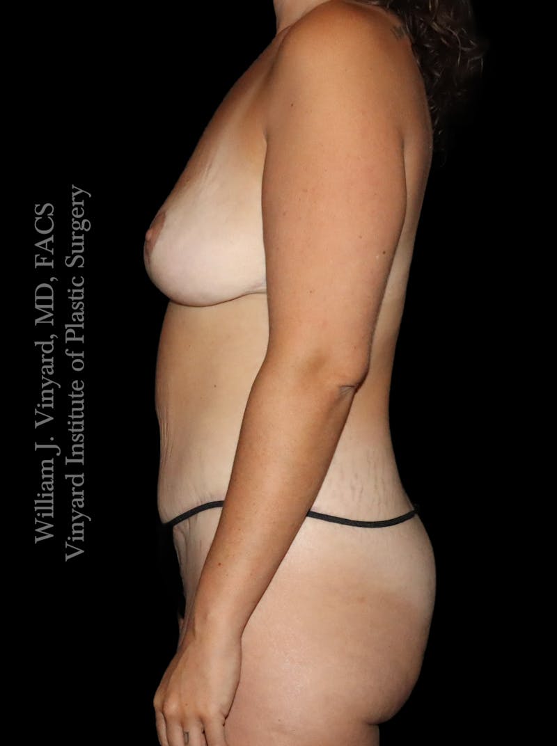 Mommy Makeover Before & After Gallery - Patient 458954 - Image 10