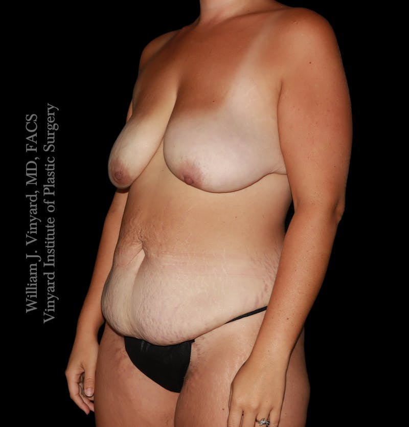 Mommy Makeover Before & After Gallery - Patient 458954 - Image 7