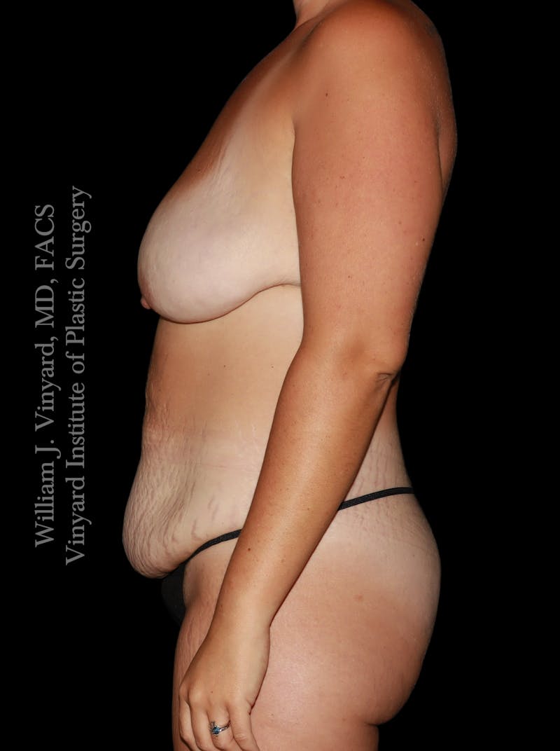 Mommy Makeover Before & After Gallery - Patient 458954 - Image 9