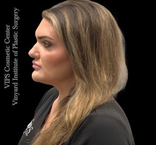 Dermal Fillers Before & After Gallery - Patient 244956 - Image 8