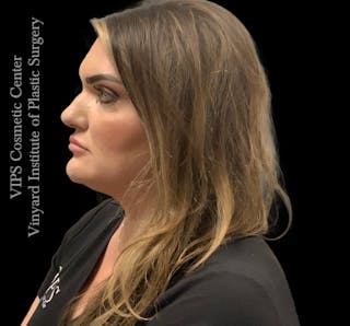 Dermal Fillers Before & After Gallery - Patient 244956 - Image 8