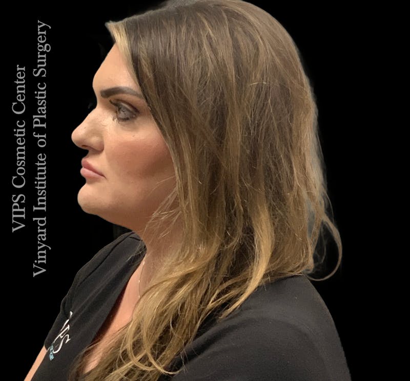 Dermal Fillers Before & After Gallery - Patient 244956 - Image 8