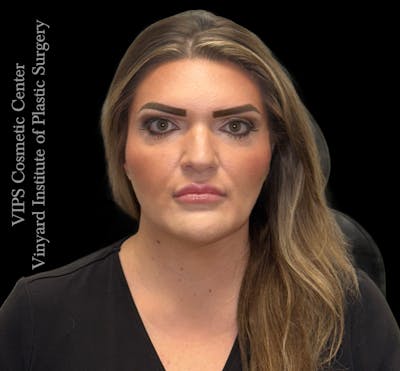 Dermal Fillers Before & After Gallery - Patient 244956 - Image 1