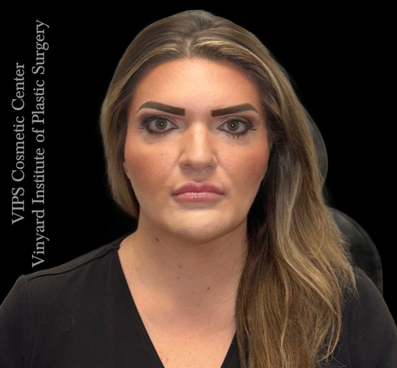 Dermal Fillers Before & After Gallery - Patient 244956 - Image 1