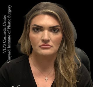 Dermal Fillers Before & After Gallery - Patient 244956 - Image 2