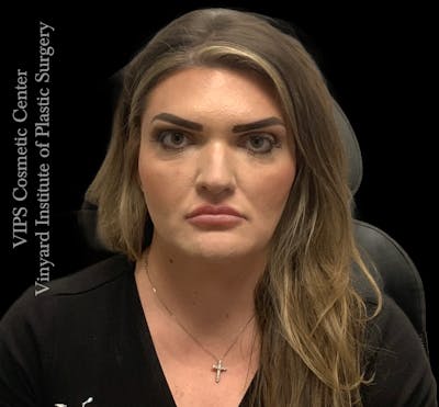 Dermal Fillers Before & After Gallery - Patient 244956 - Image 1