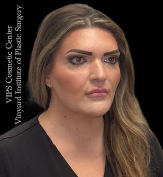 Dermal Fillers Before & After Gallery - Patient 244956 - Image 4